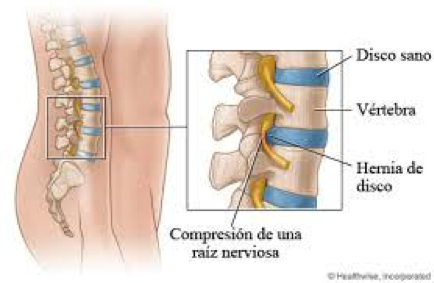 herniadiscal